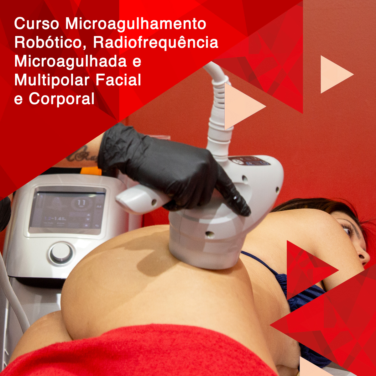 Curso Microagulhamento Robótico, Radiofrequência Microagulhada e Multipolar Facial e Corporal